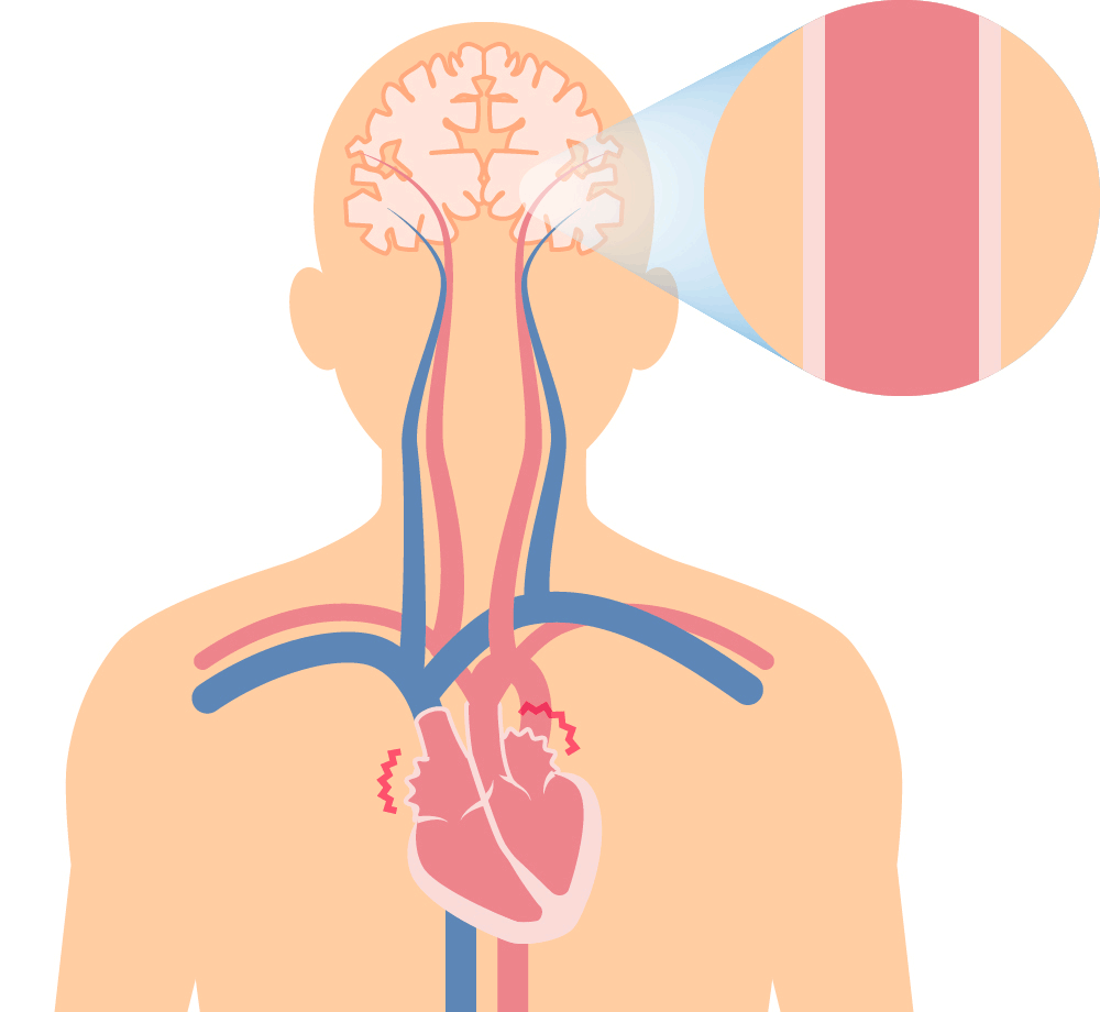 心房細動によって起こる心原性脳塞栓