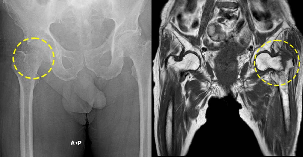 右大腿骨頸部骨折～単純X線／左大腿骨頸部骨折～MRI T1強調画像