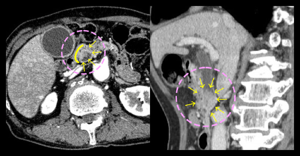 遠位胆管がん 造影CT動脈相／造影CT門脈相＊矢状断