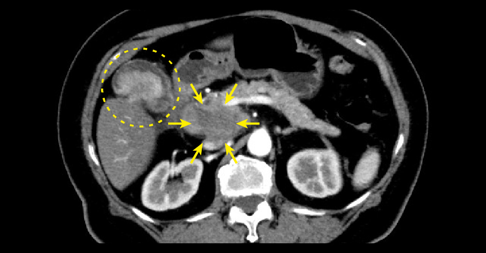 造影CT動脈相／造影CT動脈相＊水平断｜胆嚢底部に造影効果を伴う腫瘤と膵鉤部～下大静脈周囲リンパ節が一塊となって腫脹