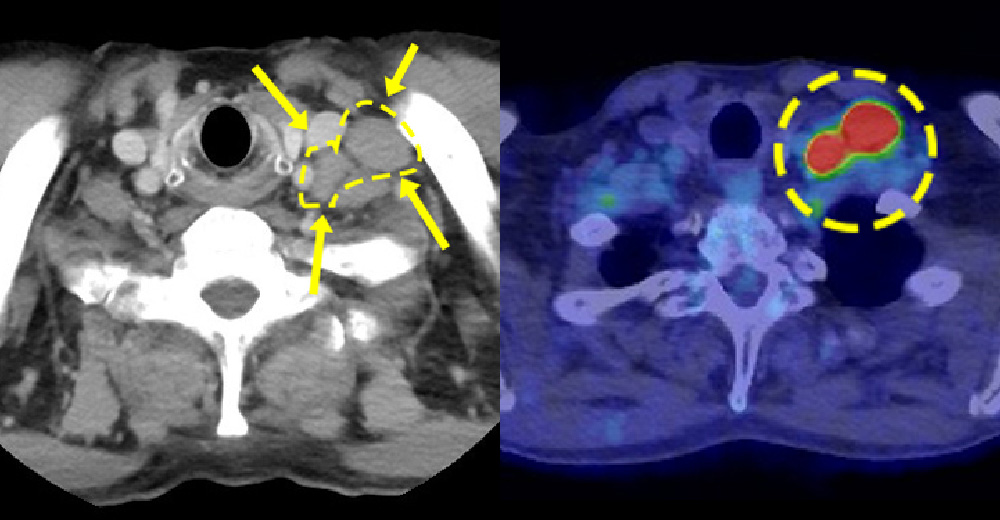 造影CT・PET-CT fusion画像