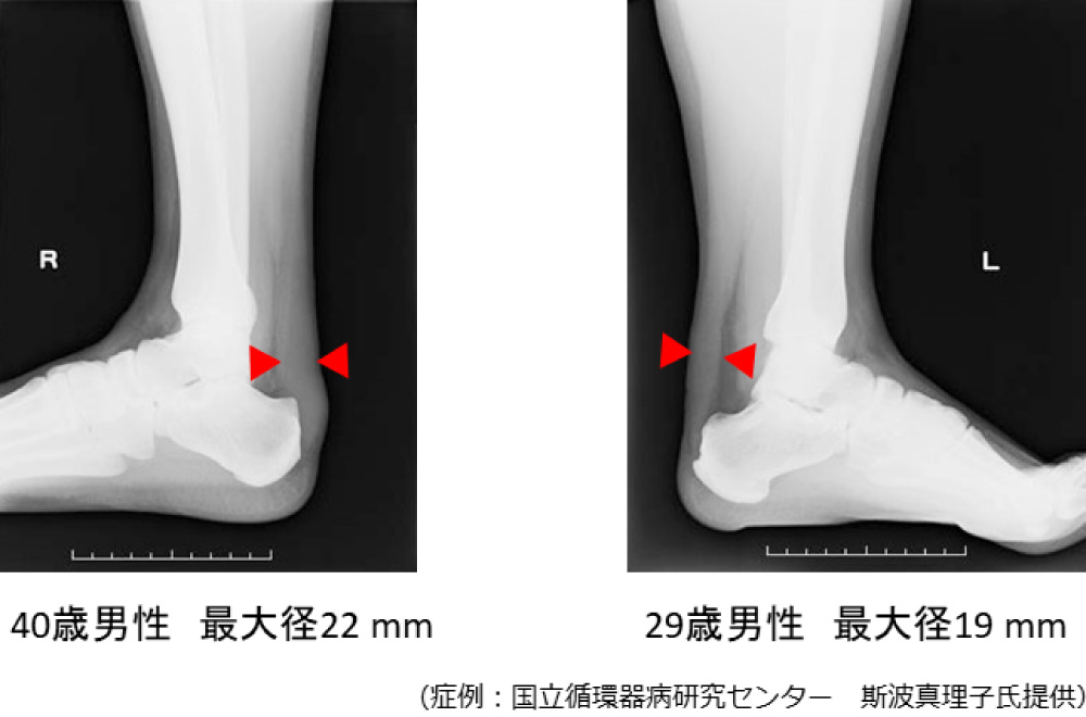 FHにおけるアキレス腱X線撮影