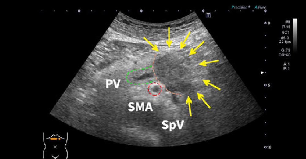 PV：門脈　SMA：上腸間膜動脈　SpV：脾静脈