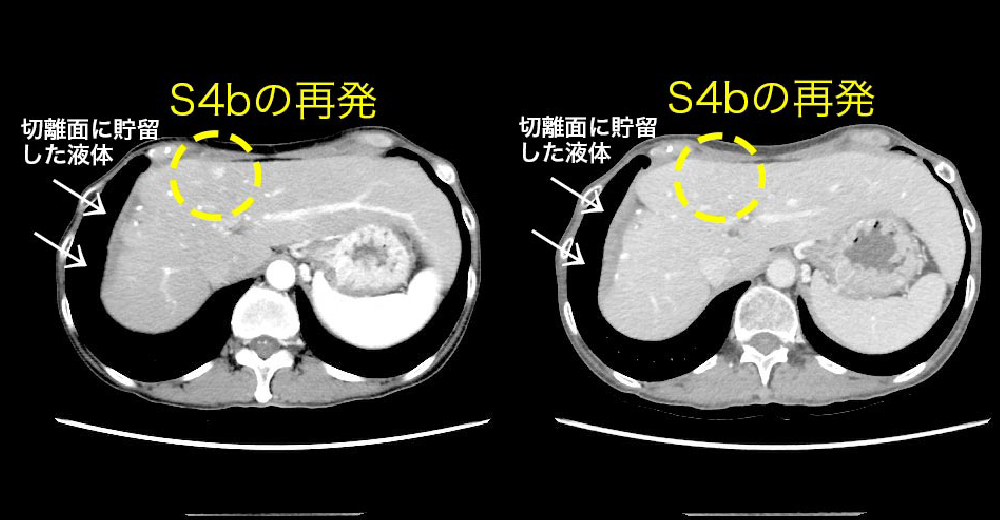 肝がん前区域切除術後 内側区域S4bに再発