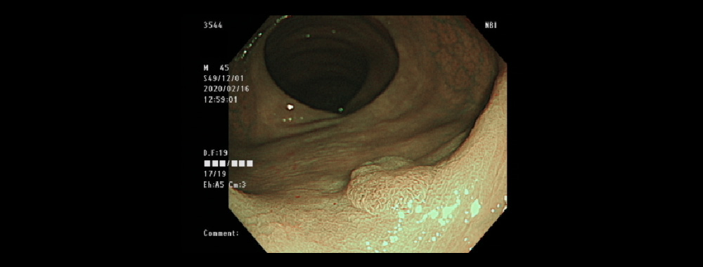 NBI　Narrow Band Imaging：狭帯域光観察　特殊な色調識別技術で、病変が強調され“茶色っぽく”見える