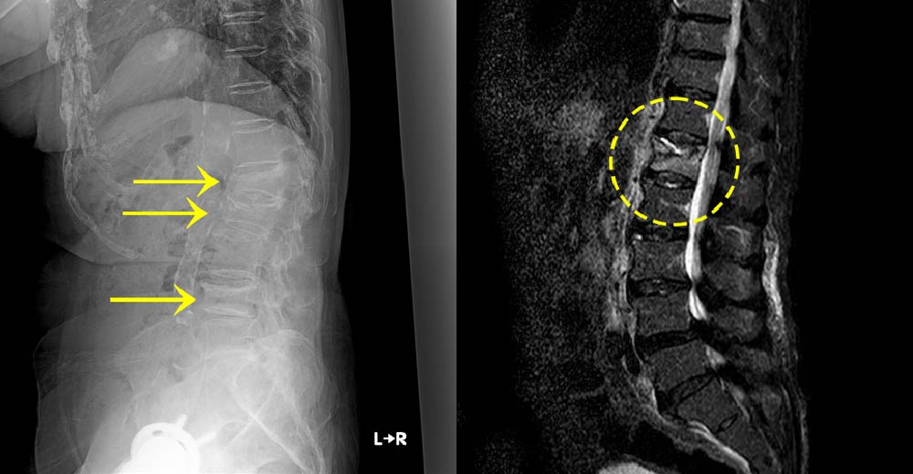 第1・2・4腰椎椎体骨骨折～単純X線／第1腰椎椎体骨骨折～MRI STIR画像