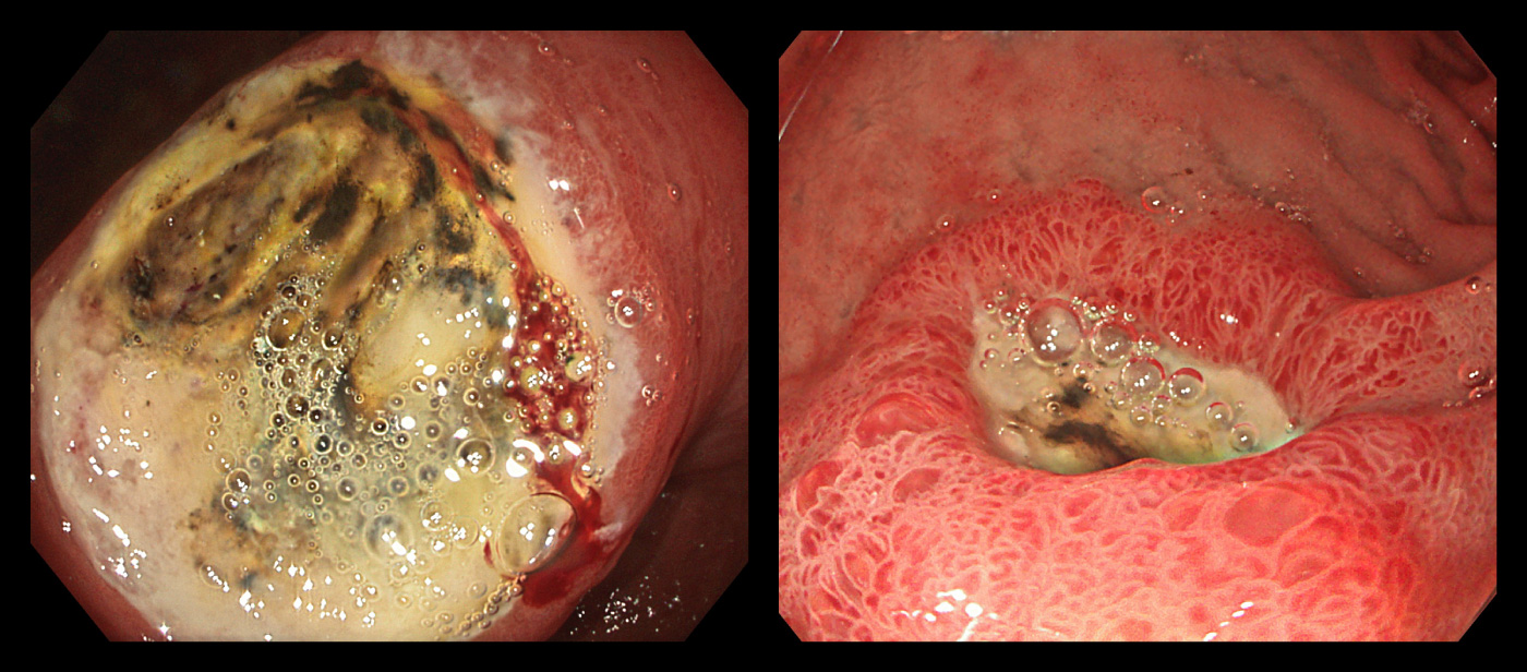 ピロリ菌感染を主因として発生した胃潰瘍