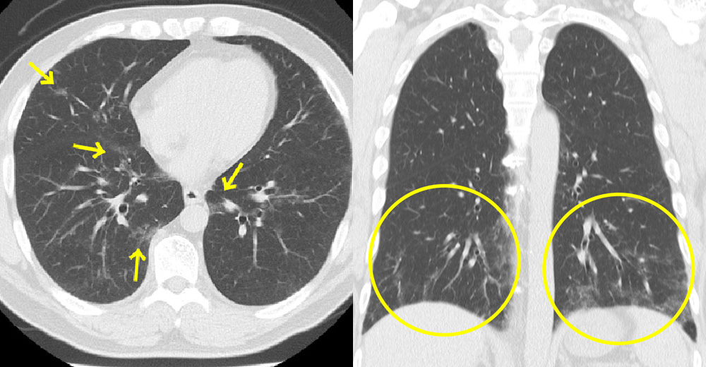 Interstitial Lung Abnormalityを伴う症例