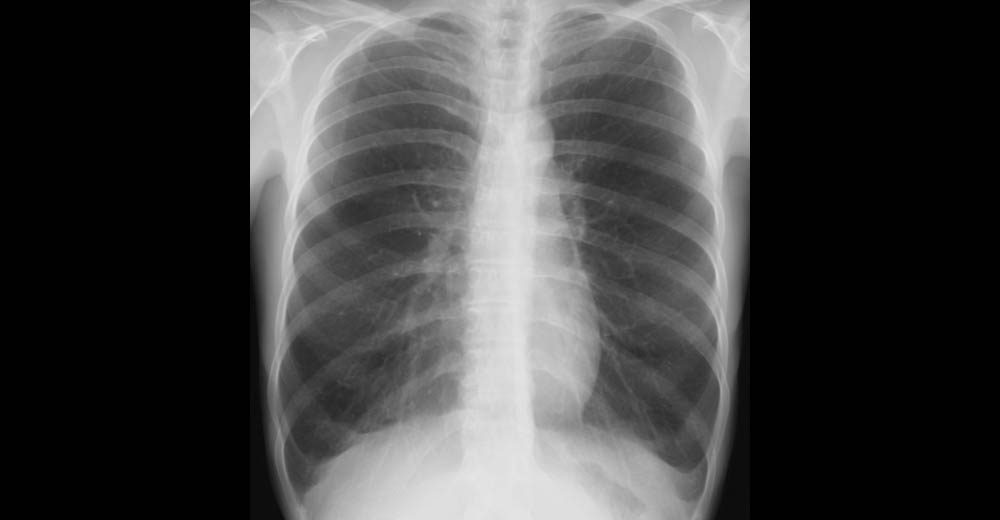 胸部X線